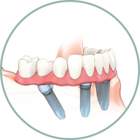 Négy implantátumon rögzített komplett híd All on four Nobel biocare Teljes fogív all-on-four fogászati implantátum beültetése