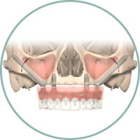 Nobel Zygoma fogászati implantáció kevés csontállomány esetén Nobel Zygoma fogászati implantáció kevés csontállomány esetén