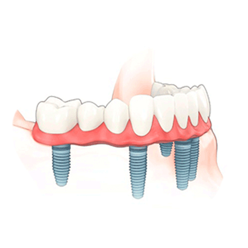 All-on-6 implantáció