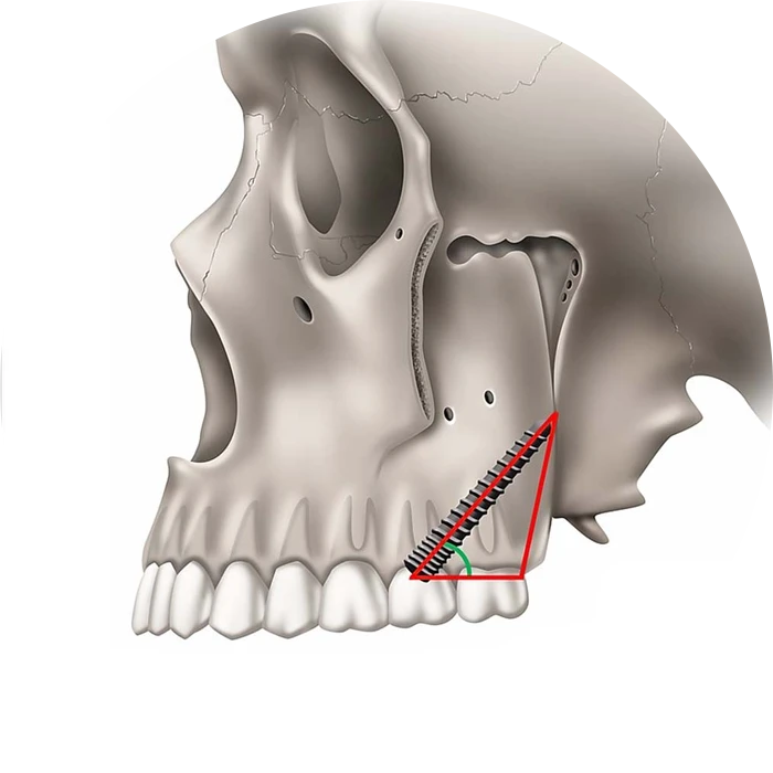 Pteryogoid implantáció