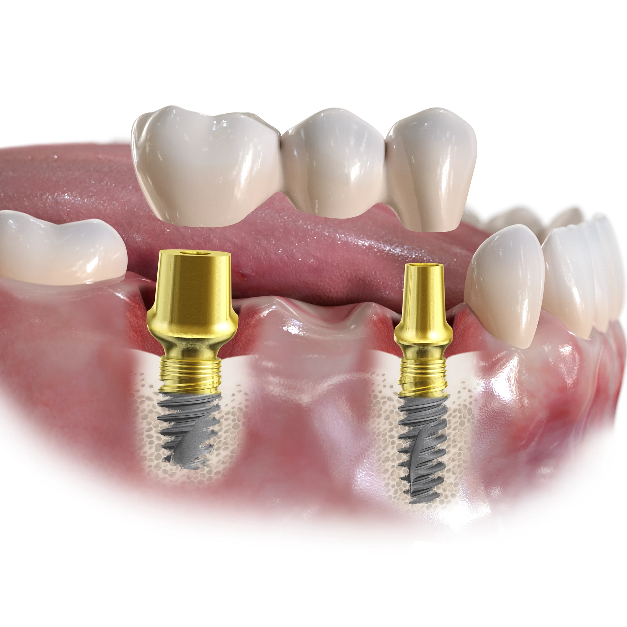 Részleges Fogpótlás, Fogászati híd implantátumon