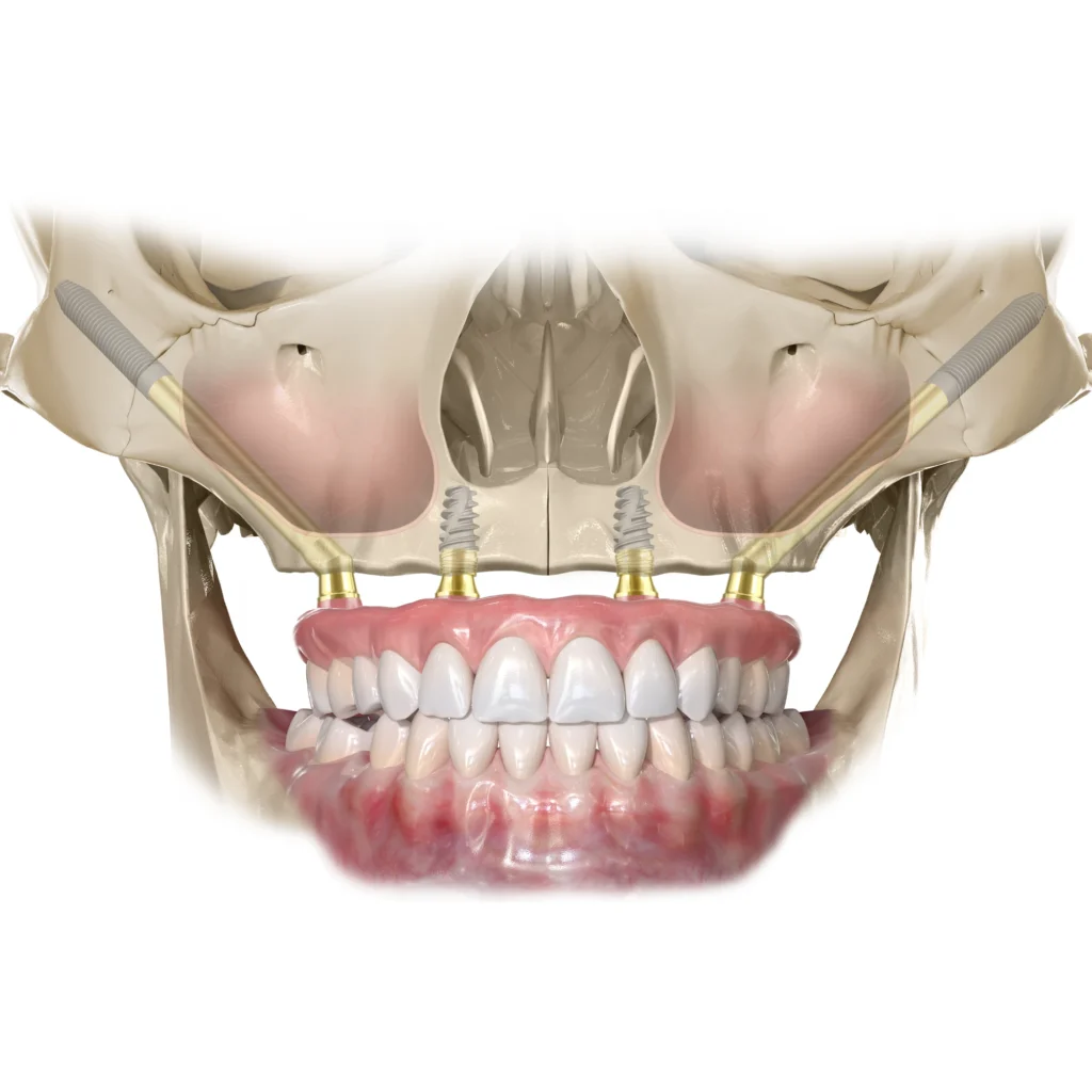 Teljes fogpotlás All-on-X Zygoma extrém csonthiány esetén